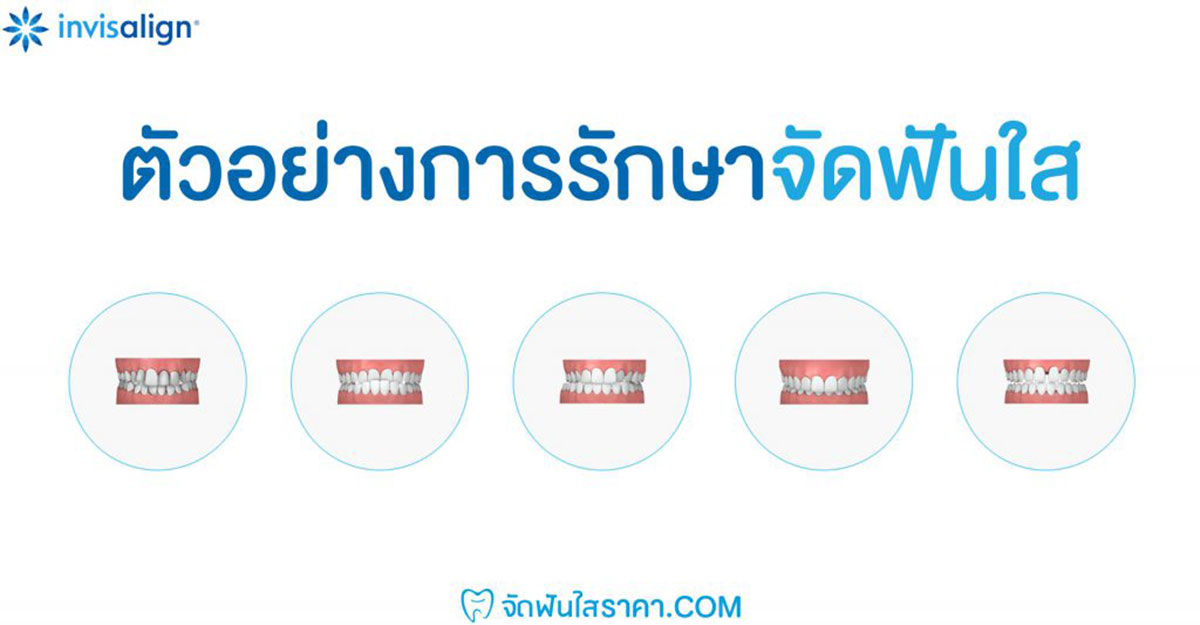 ตัวอย่างการจัดฟันแบบใส
